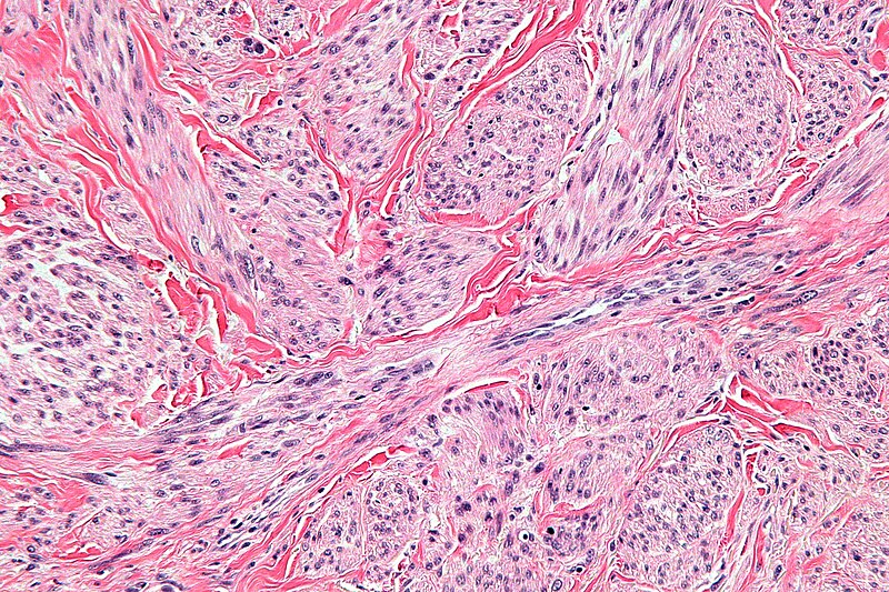 File:Cutaneous leiomyosarcoma - high mag.jpg