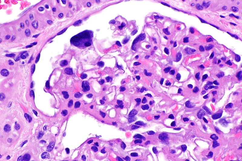 File:Cystinosis - kidney -- very high mag.jpg