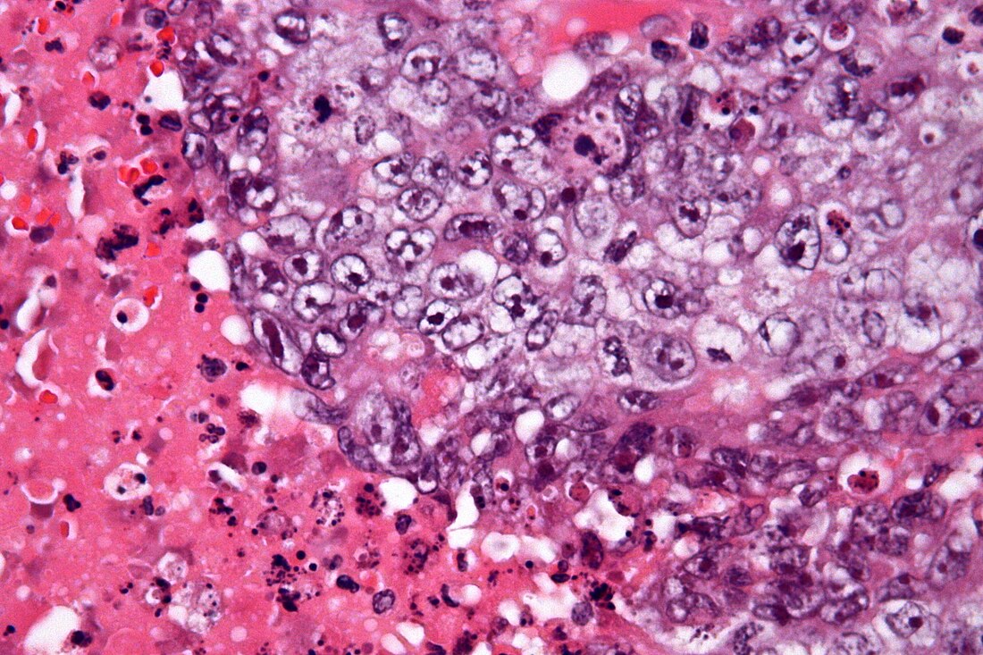 Embryonal carcinoma