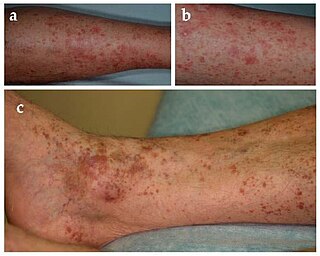 <span class="mw-page-title-main">Gougerot–Blum syndrome</span> Medical condition