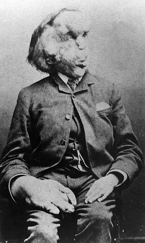 Joseph Merrick carte de visite photo, c. 1889.jpg