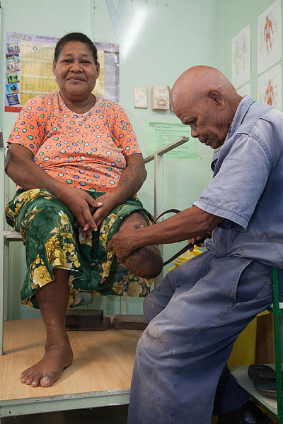 File:Jospeh Sodiasi fitting a patient Vele who lost her leg to diabetes at the National Orthotic & Prosthetic Services (NOPS), Port Moresby General Hospital, PNG. (10705852345).jpg