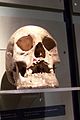 Skull deformed by leprosy