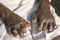 Leprosy deformities hands