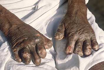 Hands deformed by leprosy