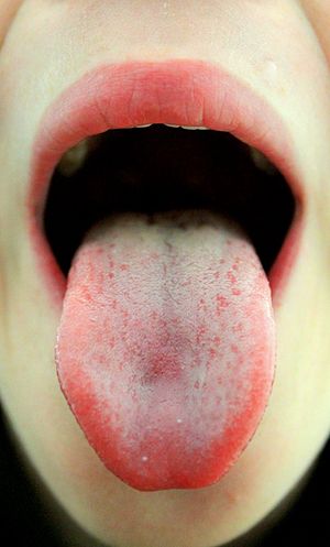 nyelv papillae fájdalom