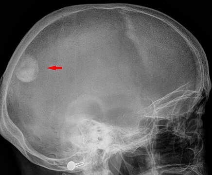 Образование под. Остеома затылочной кости рентген. Менингиома рентген черепа. Менингиома кости черепа. Остеома теменной кости черепа рентген.