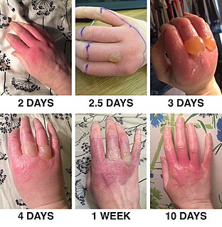 Phytophotodermatitis Skin condition caused by a chemical reaction which makes skin hypersensitive to ultraviolet light