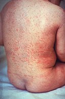 Rash of rubella on skin of child's back.JPG