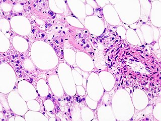 <span class="mw-page-title-main">Perivascular epithelioid cell tumour</span> Medical condition