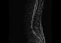 MRI lumbar spine pre-hemilaminectomy (sagittal FAST STIR)