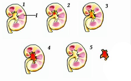 ไฟล์:Staghorn_Kidney_Stone_Progression.png