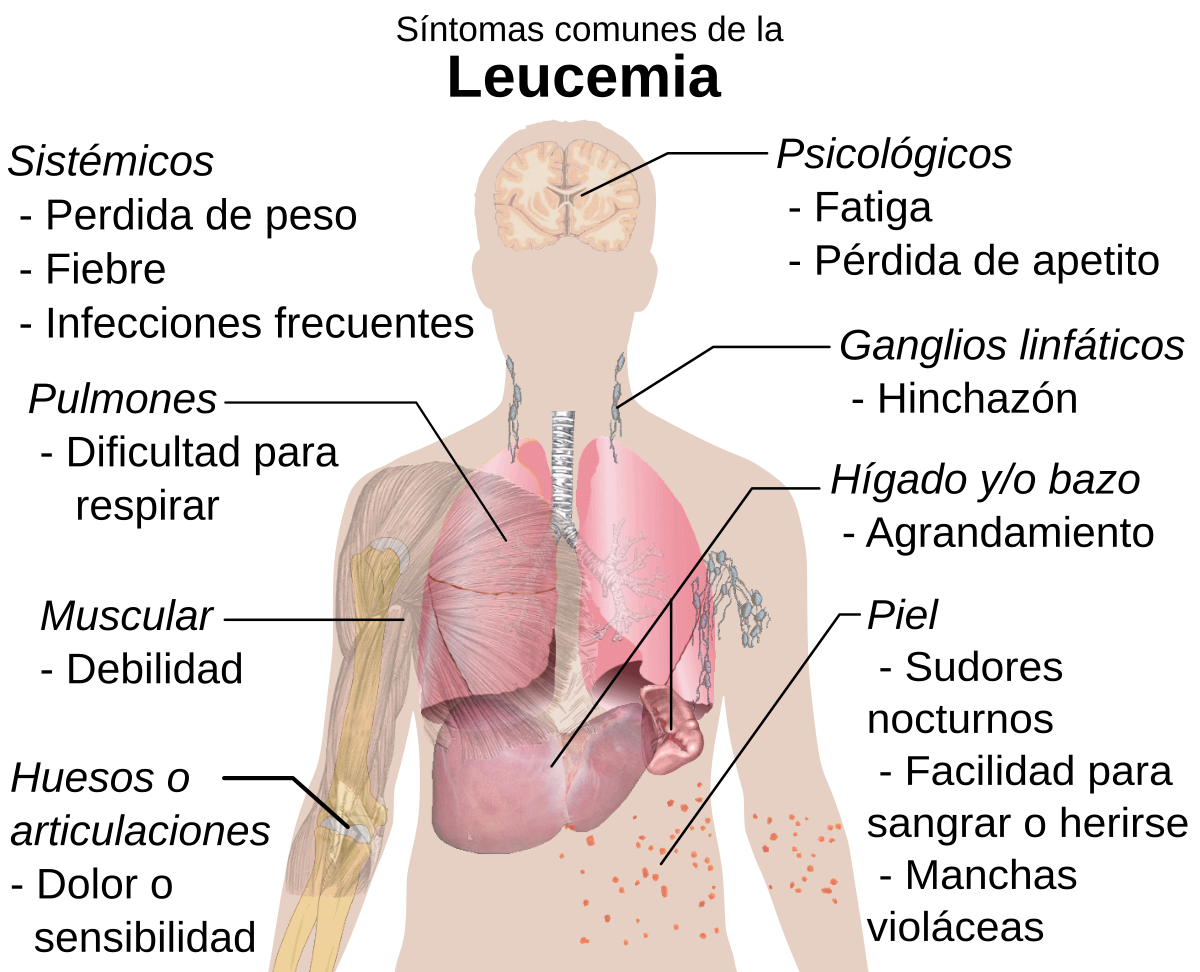 Se puede contagiar la leucemia