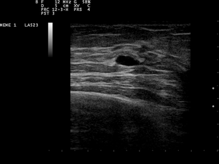 <span class="mw-page-title-main">Breast cyst</span> Medical condition