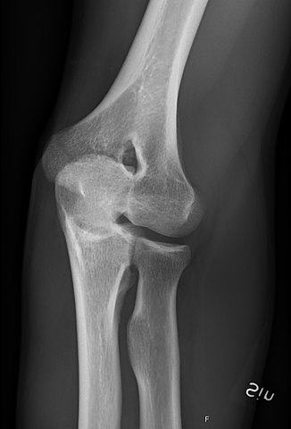 File:X-ray of normal elbow by 30 degrees external oblique ...