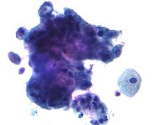 The presence of cancer (adenocarcinoma) detected on a Pap test Adenocarcinoma on pap test 2.jpg