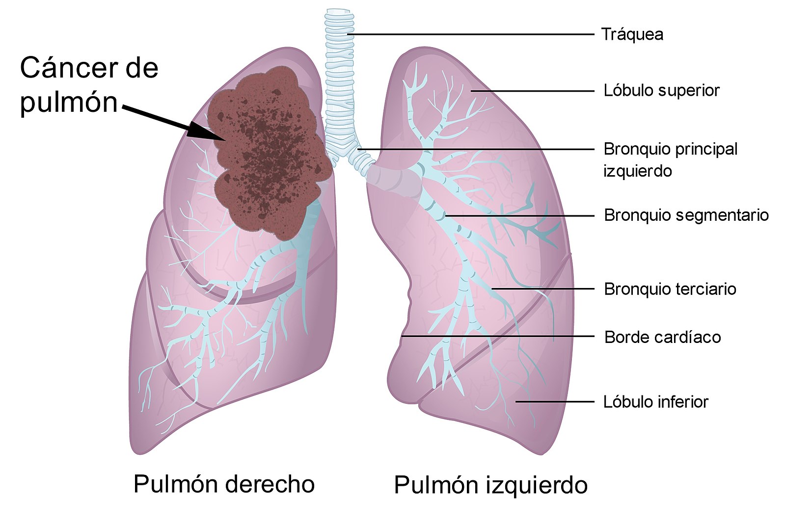 Que significa una mancha en el pulmon