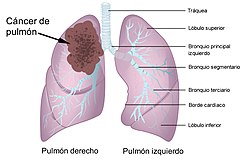 Cancro ai polmoni.jpg