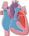 Congenital heart disease - Tetralogy of Fallot