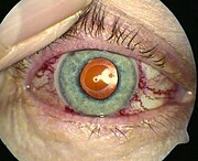 dilated blood vessels in the eye in CCF Corkscrew blood vessels in left eye.jpg
