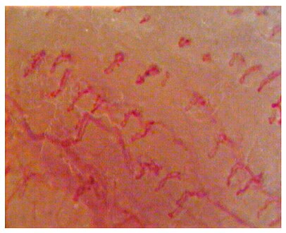 Capillaroscopic evaluation in Burning mouth syndrome