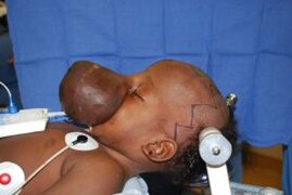 Encephalocele surgery preparation.jpg