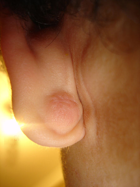 File:Epidermal Cyst ear.JPG