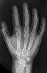 X-ray of an adult human hand