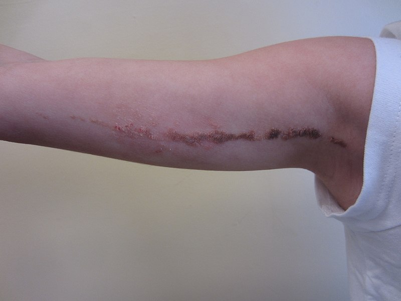 File:Inflammatory verrucous linear epidermal nevus.jpg