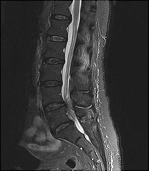 MRI of the lumbar spine with abscess in the posterior epidural space, causing cauda equina syndrome