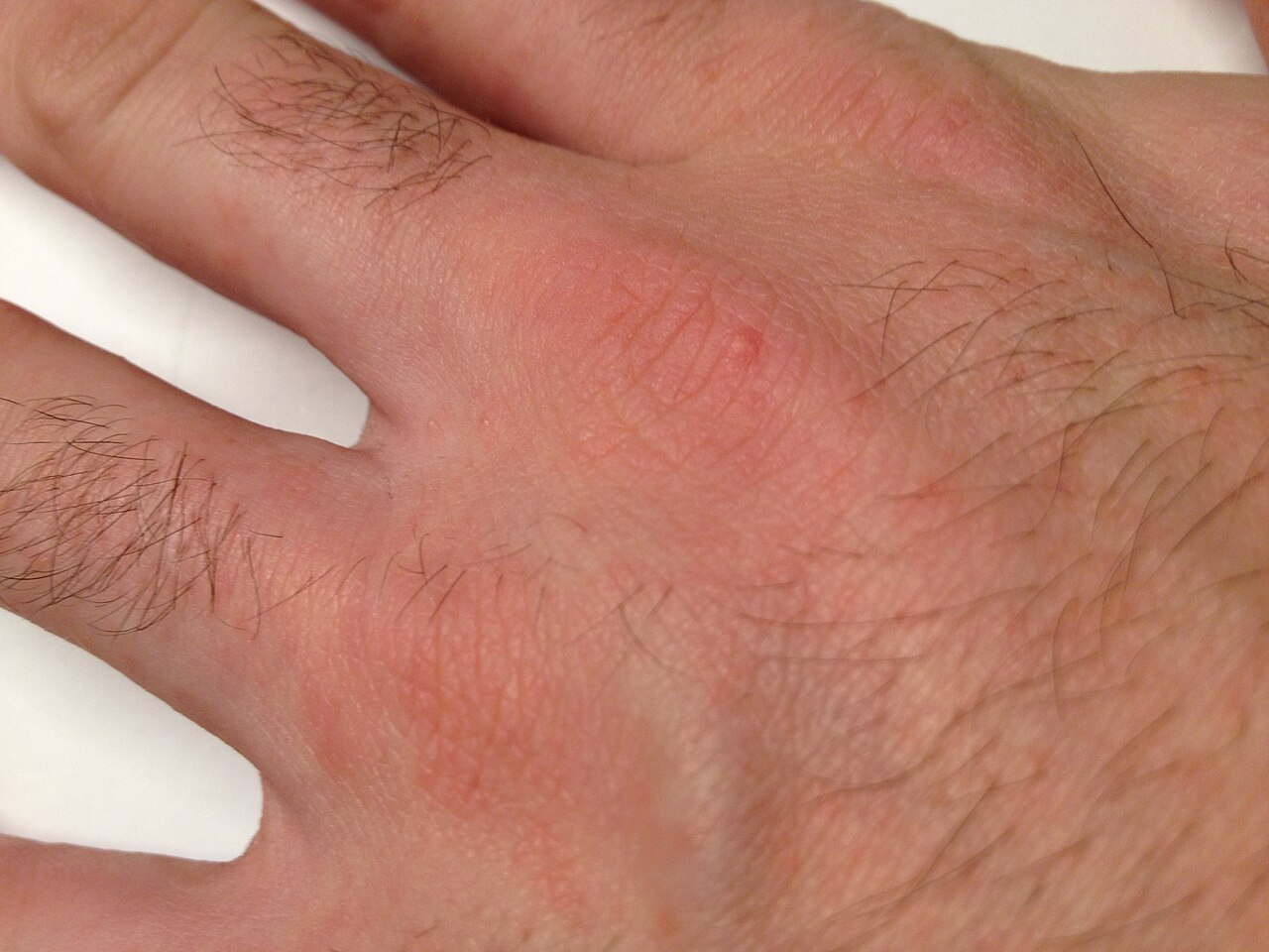 Scabies | American Academy of Dermatology