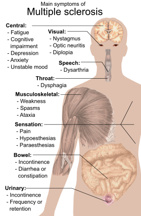 بالعربي multiple sclerosis Multiple sclerosis