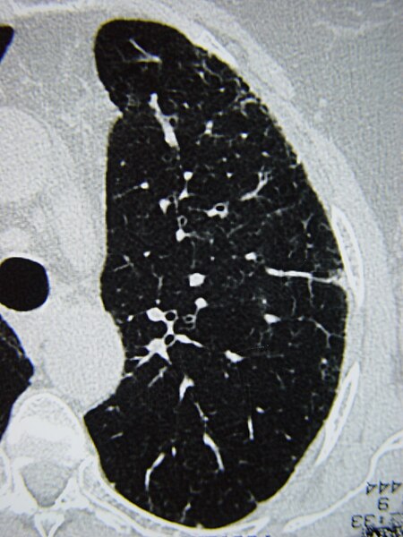 File:Systemic sclerosis case 03 pic 06.jpg