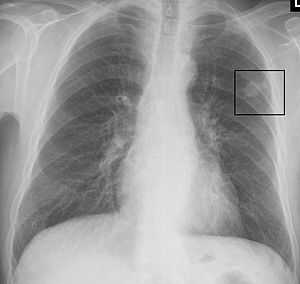 Chest X-ray showing lung cancer in the left lung Thorax pa peripheres Bronchialcarcinom li OF markiert.jpg