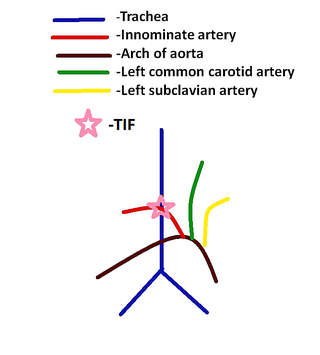 <span class="mw-page-title-main">Tracheoinnominate fistula</span> Medical condition