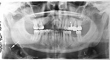 Arrows point to two vertical white lines which is how calcifications in the first part (proximal component) of the internal carotid artery appear on panoramic radiographs. X-ray64A.JPG