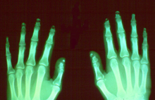 Early changes of acroosteolysis can be detected by x-ray. In this radiograph there is dissolution and fragmentation of the bone in several of the terminal phalanges.~CDC Acroosteolysis- x-rays.png
