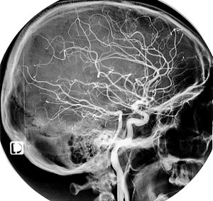 Artère Carotide Interne: Trajet, Fonction, Pathologie