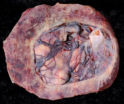 Circumvallate placenta