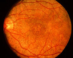 "Salt-and-pepper" retinopathy is characteristic of congenital rubella.[17]