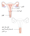 Diagram showing a radical hysterectomy with a reconstructed vagina CRUK 076-ar.png