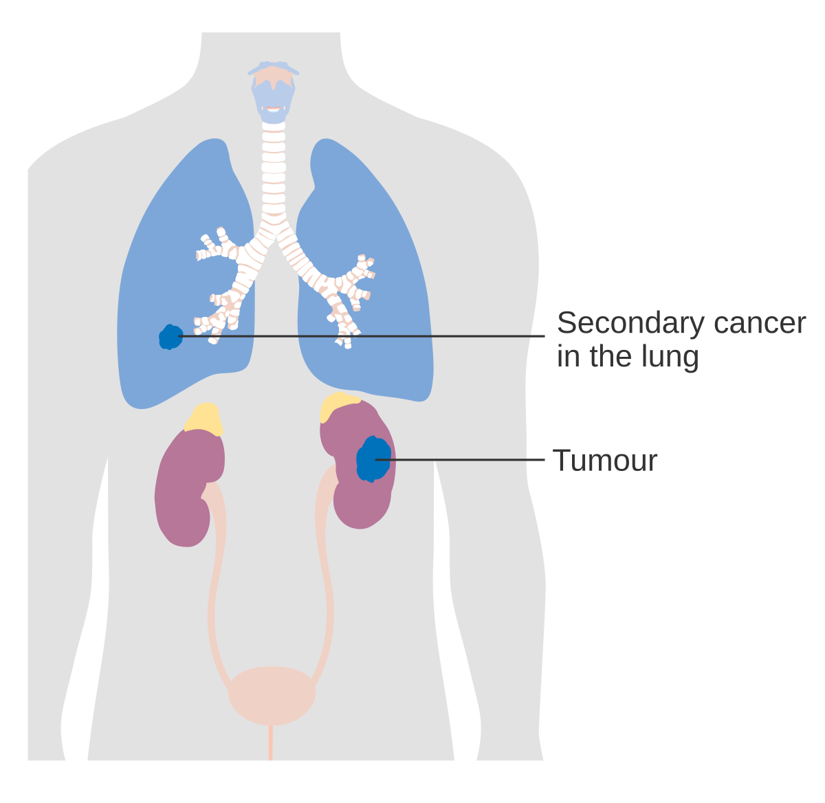 Cáncer de pulmón etapa 4