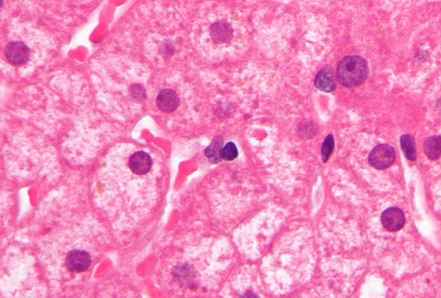 Micrograph showing lipofuscin, in brown/yellow, in a liver biopsy with ground glass hepatocytes; H&E stain