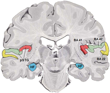 red:Brodmann area 41, green:Brodmann area 42, note 1: BA41 is bounded medially by Brodmann area 52 and laterally by BA42, note 2: pSTG is posterior part of the superior temporal gyrus Human temporal lobe areas.png