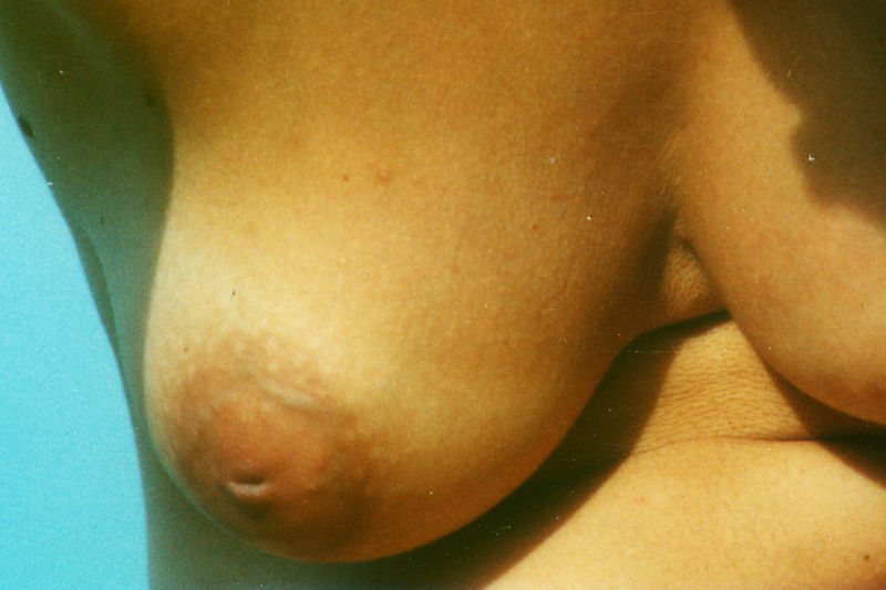 File:Inverted-nipple-01.jpg