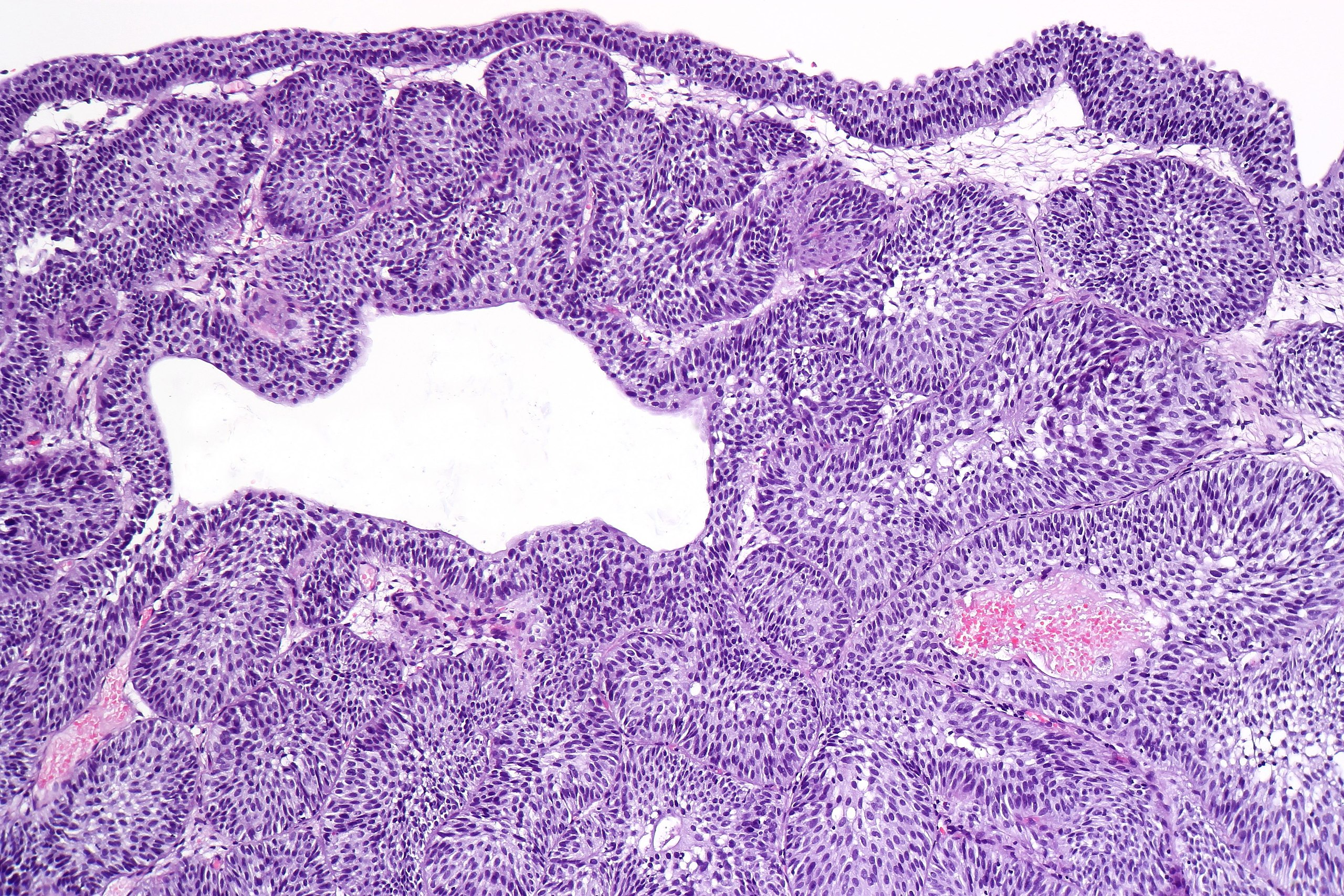 Urothelial inverted papilloma pathology outlines