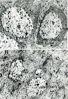 Lead exposure damages cells in the hippocampus, a part of the brain involved in memory. Hippocampi of lead-exposed rats (bottom) show structural damage such as irregular nuclei (IN) and denaturation of myelin (DMS) compared to controls (top). Lead-exposed rat hippocampi.jpg