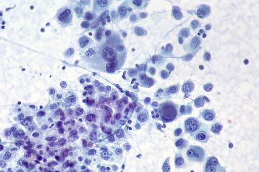 Malignant Melanoma, Liver FNA, Direct Smear, Pap Stain (8191269068)