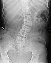 X-ray of individual with scoliosis Medical X-Ray imaging GEX04 nevit.jpg