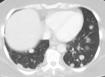 Metastatic cancer in the lungs